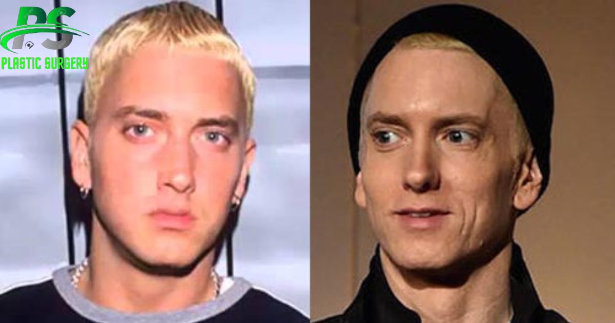 Did Eminem Get Plastic Surgery Step By Step Guide...Discover the truth ...