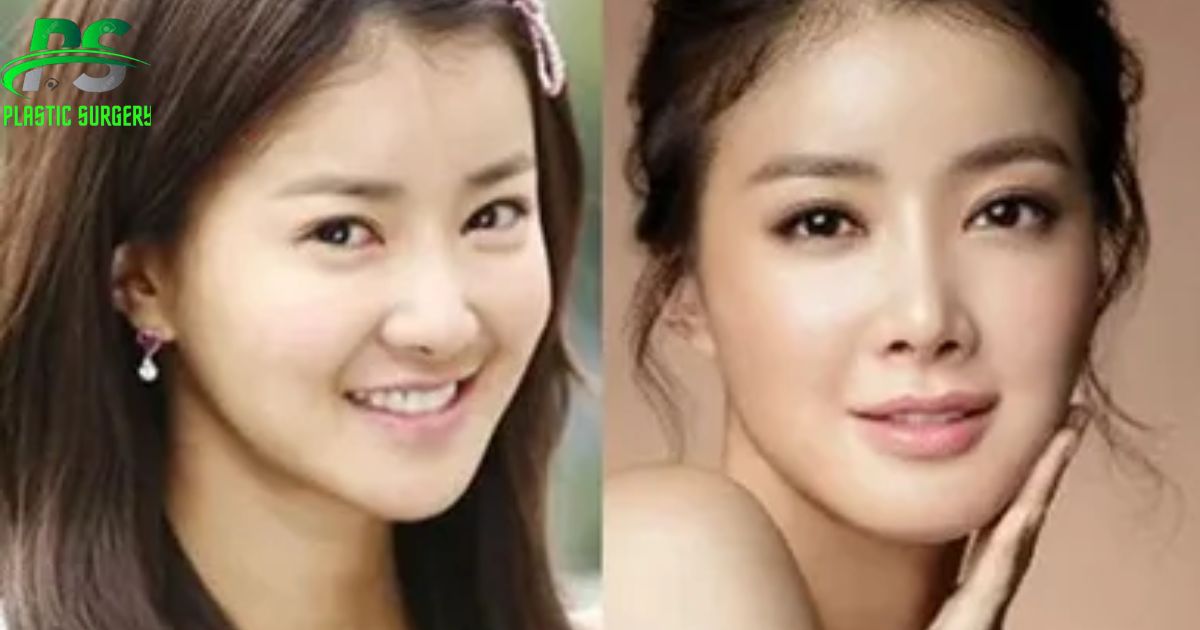 Choi Min-Young Plastic Surgery