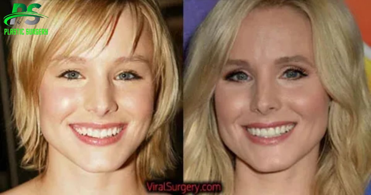 Kristin Bell Plastic Surgery